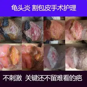 包皮手术后专用私处开裂水肿伤口愈合快速结痂安信银离子消毒凝胶