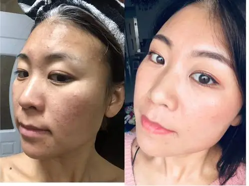 nuskin使用前后皮肤对比汇总(更新中)