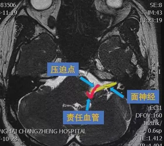 磁共振检查如3d-tof-mra,fiesta等,有助于明确责任血管和面神经之间的