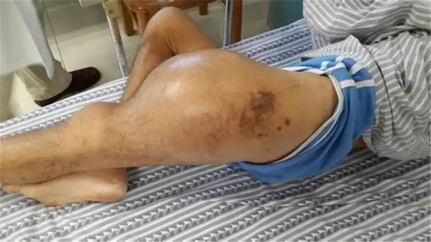 腿部巨大骨肉瘤高清图片_有来医生