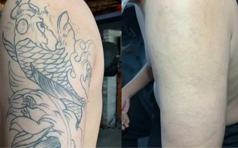大臂纹身清洗4次真实效果对比,马上干净了!