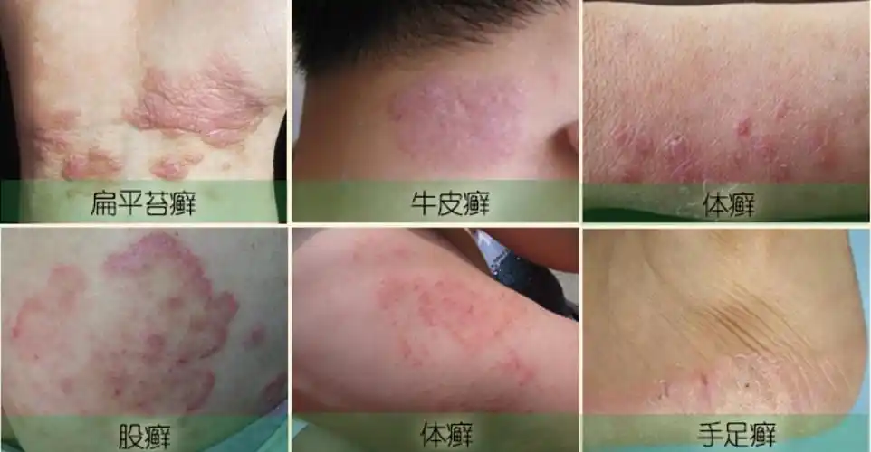 【长沙皮肤病医院科普】体癣与股癣的区别和治疗方法解析_身体_真菌