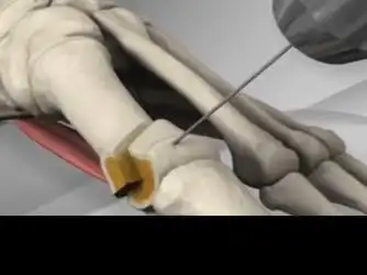 拇外翻手术3d动画