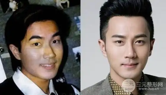 刘恺威整容前后对比 tvb小鲜肉也有"不堪回首"的过去?-整形医院排行榜