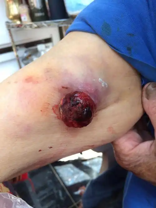 肉瘤是一种恶性肿瘤,其来源于间叶组织(包括结缔组织和肌肉),在肿瘤中