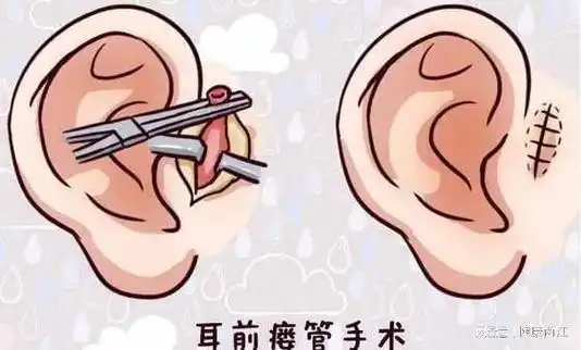 我没打耳洞呀!为什么耳朵有个小洞洞?|手术|内镜|囊肿|外科|瘘管|肿物