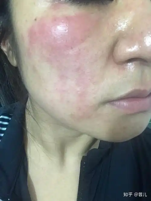 皮肤敏感大致情况是脸颊的颧骨处会有红斑涂抹各种护肤品会有刺痛感