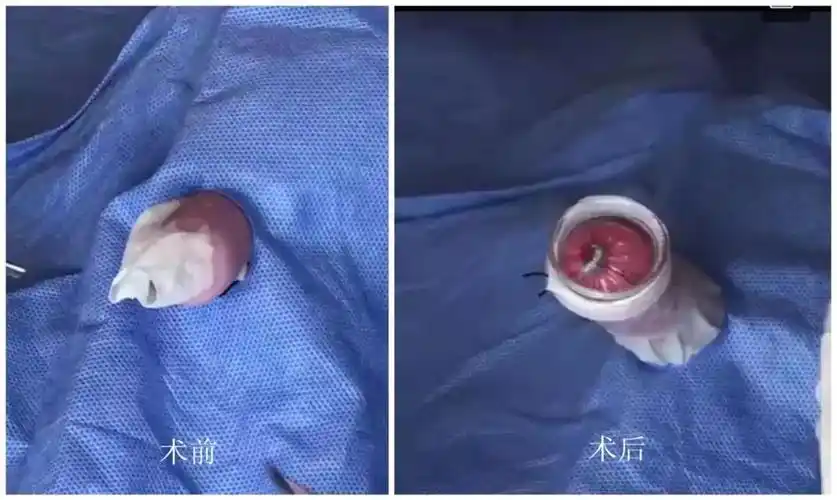 伦教暑期男孩们扎堆割包皮小弟弟听听医生怎么说