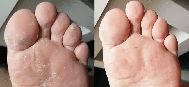 一招让"烂脚丫"彻底消失