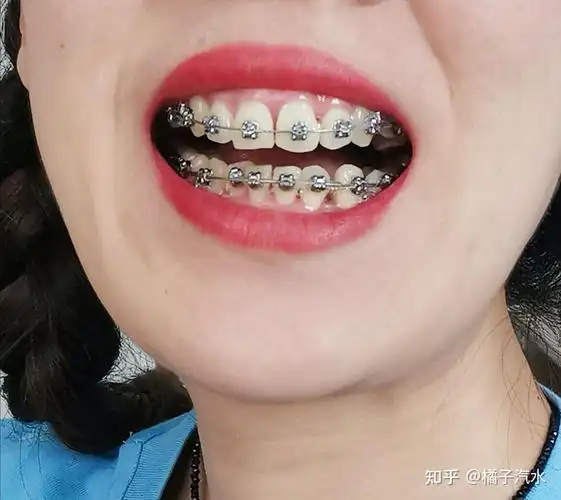 25岁高龄少女虎牙矫正记录