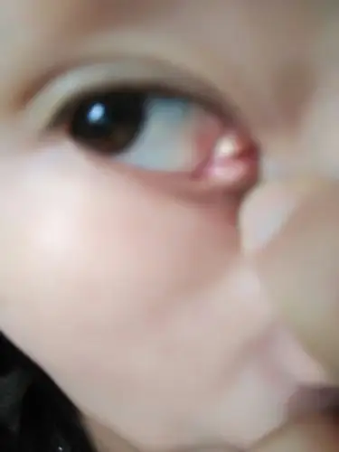 内眼角长了一颗看上去黄色的东西,有点摸上去有点硬硬的,平时没啥感觉