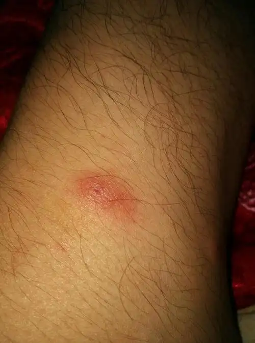 请各位有经验的医师帮忙看下张的这个红疹是个什么东西,比较痒抓的