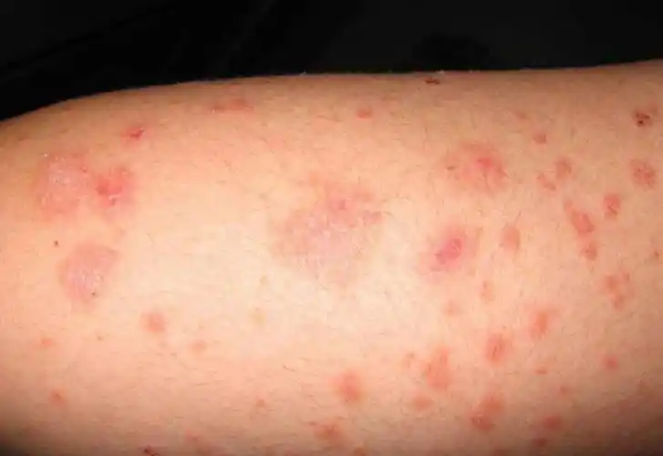 痈疮的热毒证的患者,禁吃鱼类,虾类腥臊,姜,椒,酒等辛温一类食材,皮肤