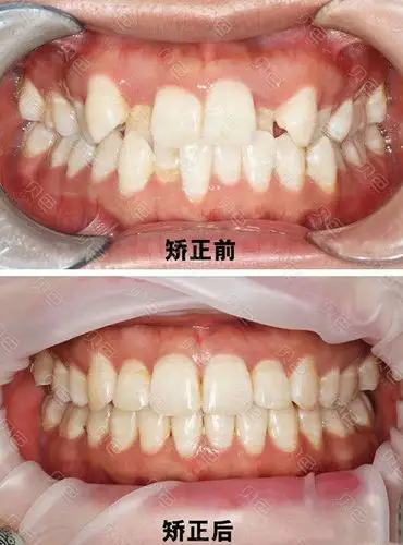 济宁壹颗芽口腔虎牙矫正