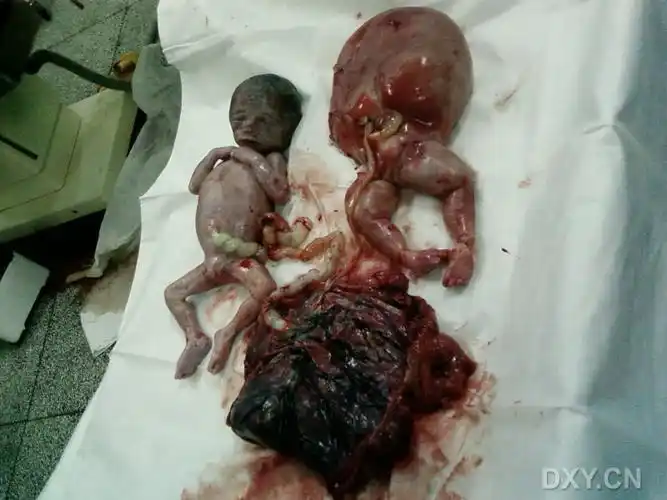 【共享】胎儿畸形图片