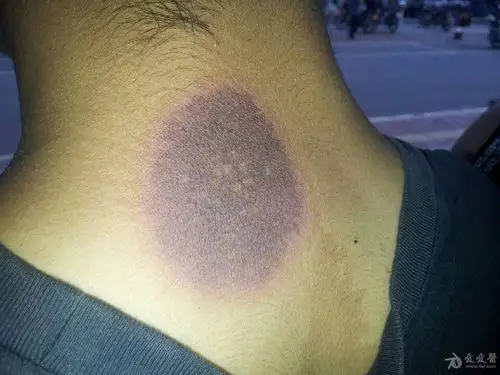 颈部黑块sss - 皮肤及性传播疾病讨论版 - 爱爱医医学论坛