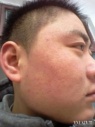 揭秘脸起皮是怎么回事 快速了解有效预防脱皮