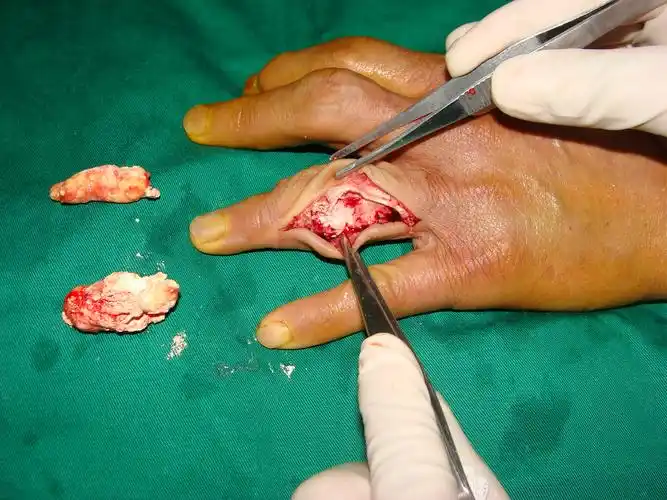 痛风石的手术治疗