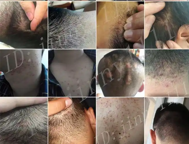 本去头皮毛囊炎痘痘糠比孢子菌马拉色菌毛囊炎克星