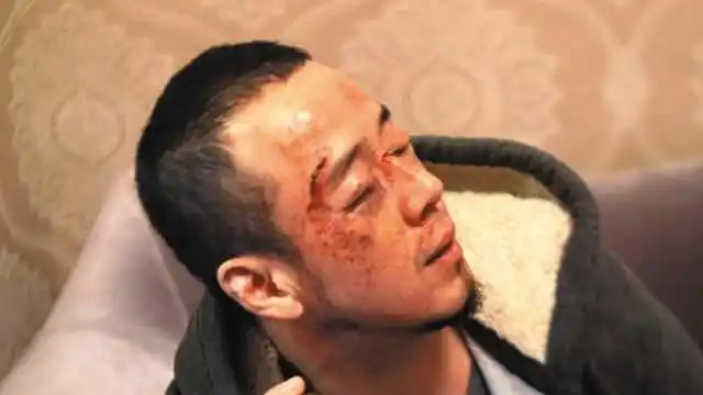 杨坤面部受伤 眉骨留血疤