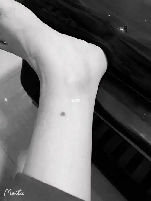 好多年前,左脚内侧突然长了一颗皮下痣