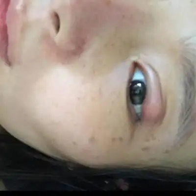 怀孕七个月,眼睛上这个忽然长这麼大,红肿,怎麼 办?在线等