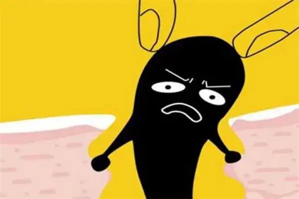 黑头是怎么产生的 黑头可以挤吗