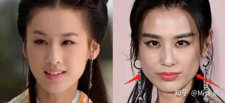娱乐圈其实很多女明星也都出现了这样的问题,原先都是小v脸,现在都