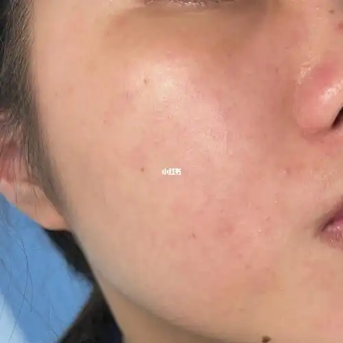 屏障受损_屏障受损_口罩_皮肤屏障受损_美妆_护肤_护肤其他