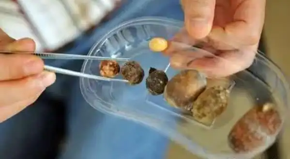 会导致尿酸结晶出现,从而会产生一些小的尿酸结石,会随尿液排出,从而