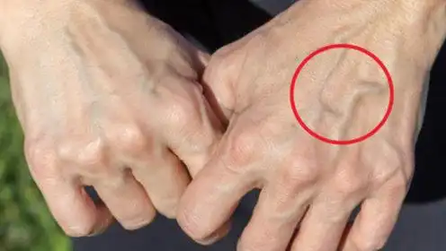 肝癌发现就是晚期,医生:一旦手上出现这东西,别怀疑,是癌!