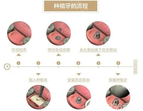 55岁种牙需要多少钱想问下老妈在安庆朱小龙口腔做登腾种植牙6000贵不