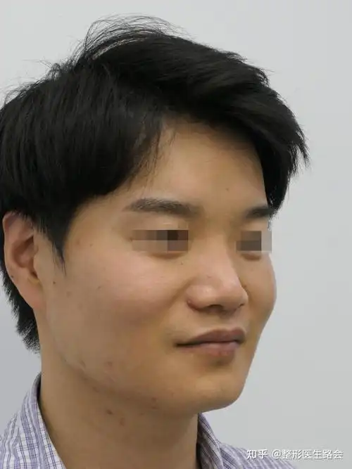 30岁男士,塌鼻子显土气,全膨体隆鼻改造后:变帅气了!