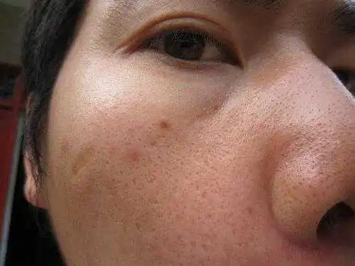 毛孔粗大是几乎每个女孩子的噩梦,谁不想一直拥有婴儿般细腻的皮肤呢?