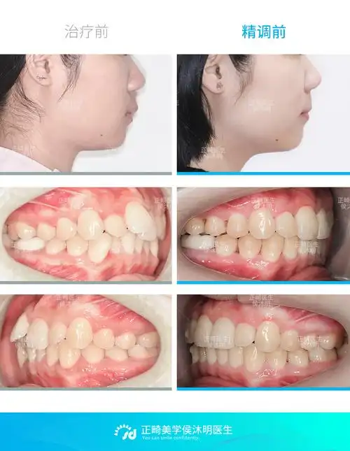 侧面牙齿及口内对比.jpg