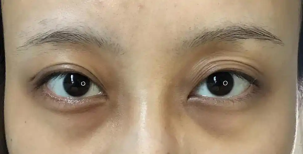 大小眼眼皮松弛我还有救吗姐妹们慎入