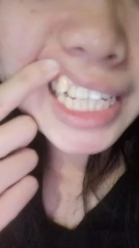 这虎牙能不能拔