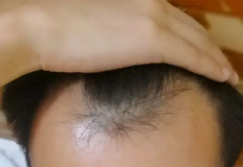 父母都没有秃顶,25岁小伙却严重m型脱发,担心以后找不到对象_手机搜狐