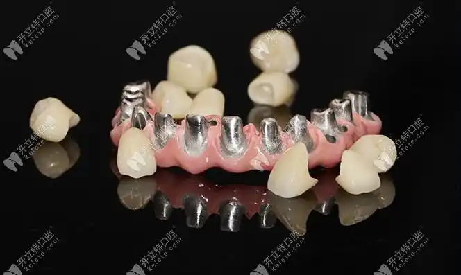 为了研究马龙桥种植修复是什么,我把优缺点和原理都搞懂了