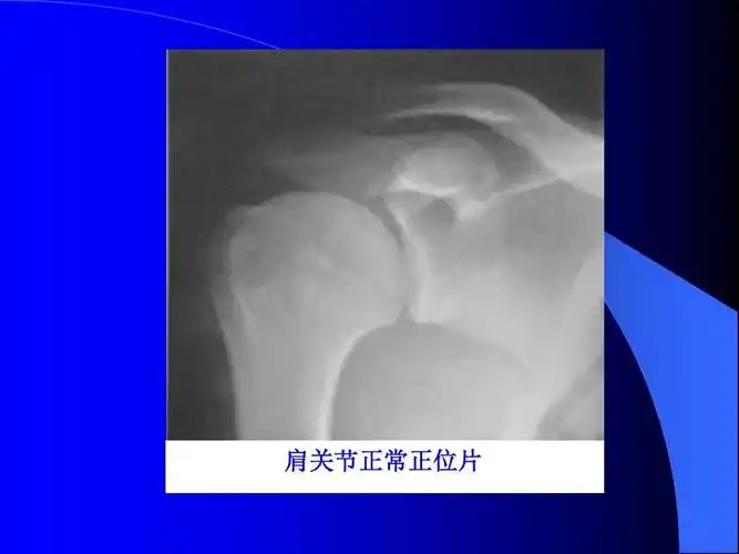肩关节正常正位片