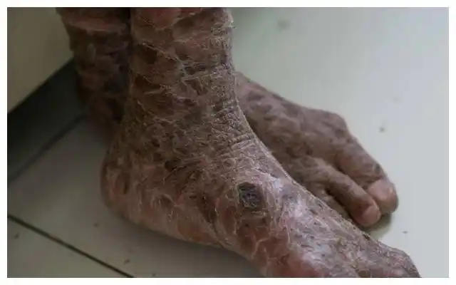 印度七岁女孩被怪病席卷,皮肤变得像石头,苦不堪言如同人间地狱