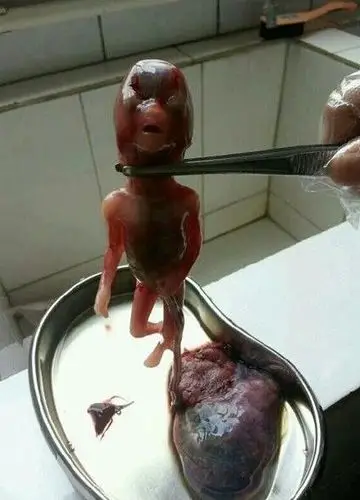 血淋漓的堕胎照片 看了你还忍心堕胎吗?