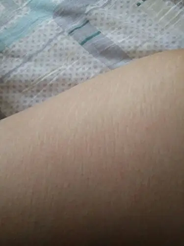 本人女,22岁,大腿内侧有就像花斑那样的,这是什么情况啊,求解惑啊!