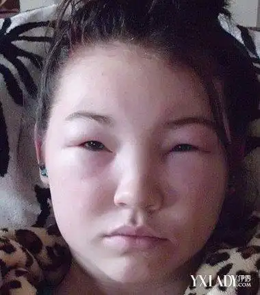 脸部浮肿该吃什么调理