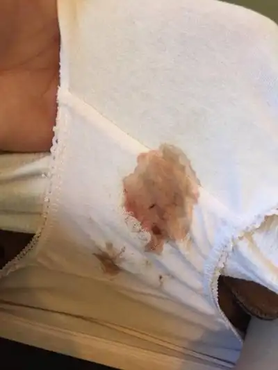 白带带血图片49