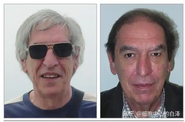 pd1那些神奇副作用白发变黑发还可作为起效标志