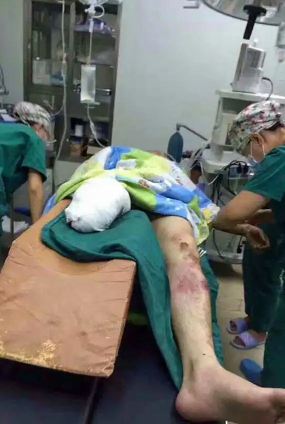 经检查老人只有些许轻微的擦伤,但徐前凯伤势严重,需要进行截肢手术.