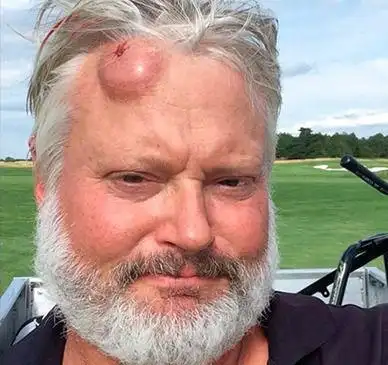 盘点-乱飞高尔夫球击中无辜人士 留下五花八门伤