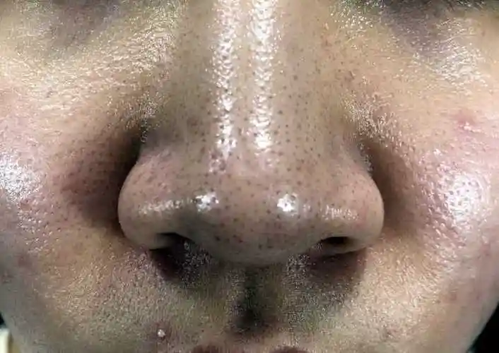 角质层厚一般会有如下感受