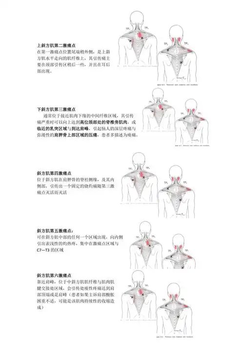 肌筋膜激痛点治疗肩背部之斜方肌